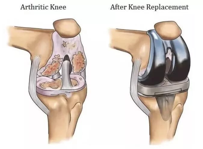 Mastering the Total Knee Arthroplasty Protocol: Insights for Better Outcomes
